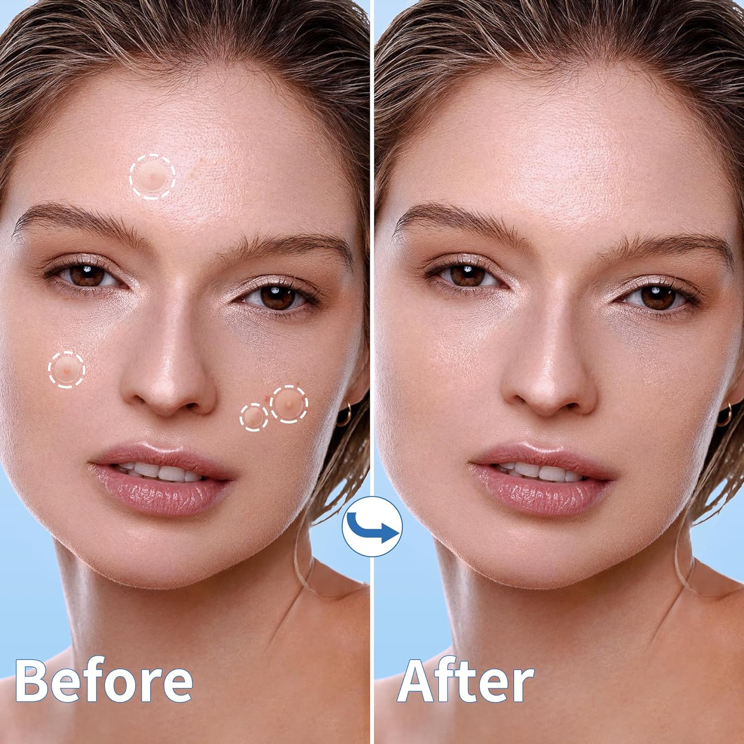 Spuogų pleistriukai, 300 vnt.