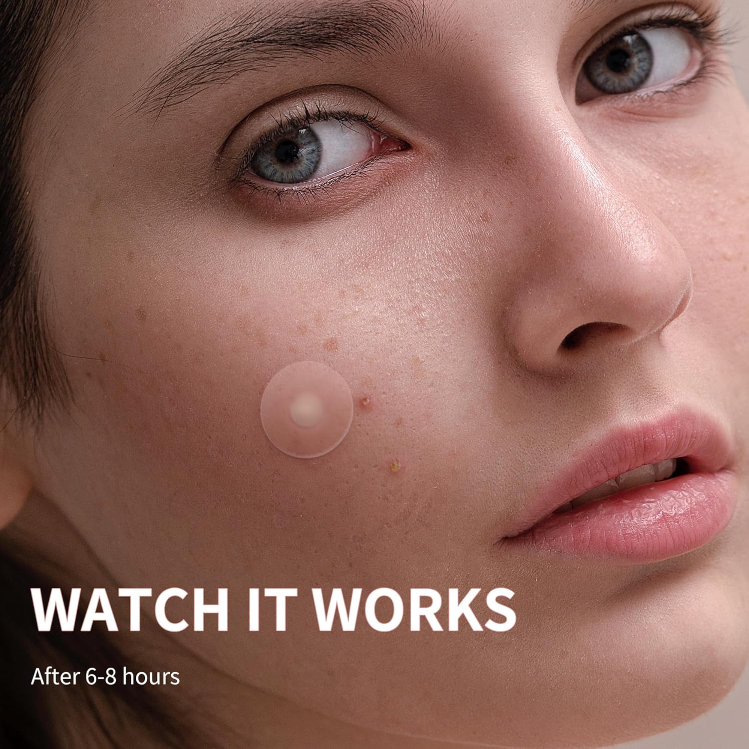 Spuogų pleistriukai, 300 vnt.