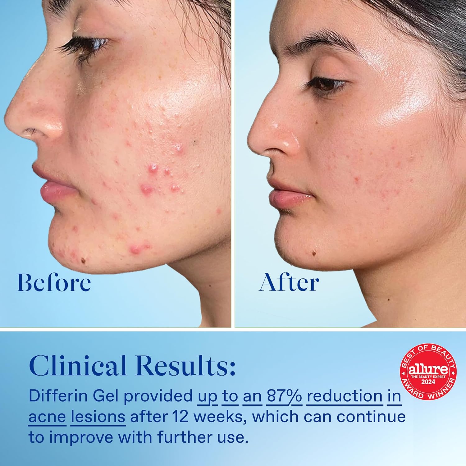 Differin spuogų gydymo gelis